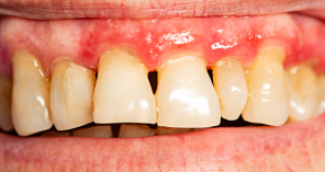 periodontal disease